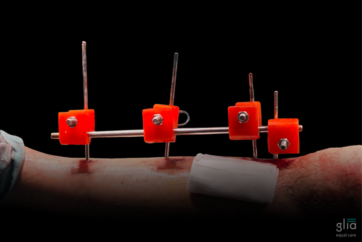 Image of Glia's External Fixator Installed on a Patient's leg.  Stainless Steel Pins with Bright orange 3d Printed Clamps.